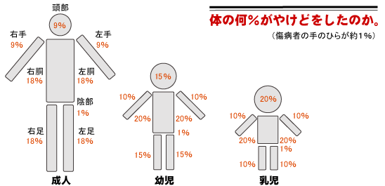 熱傷(やけど)の広さを判断する図